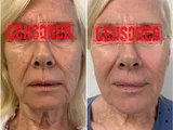 Scarlet-S RF: Strakkere huid, kleinere poriën en een frissere uitstraling