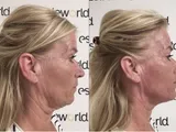 Scarlet-S RF: Strakkere huid, kleinere poriën en een frissere uitstraling