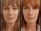 Scarlet-S geadviseerd door Dermatologen