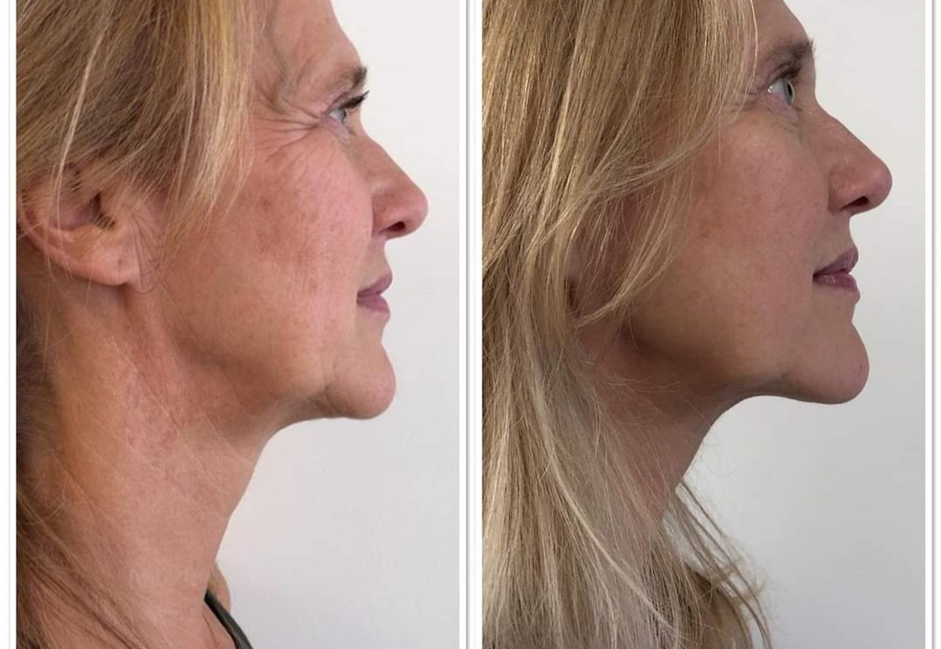 BN'er Ingeborg Wieten enorme huidverstrakking