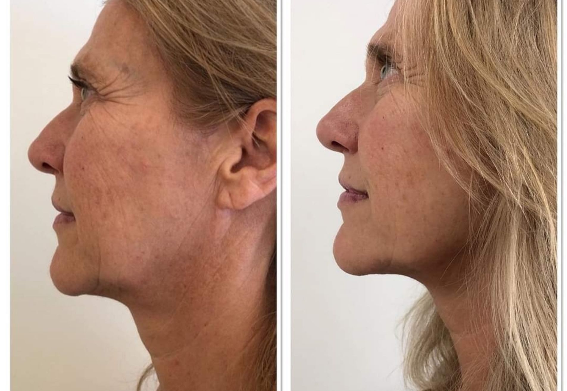 BN'er Ingeborg Wieten enorme huidverstrakking