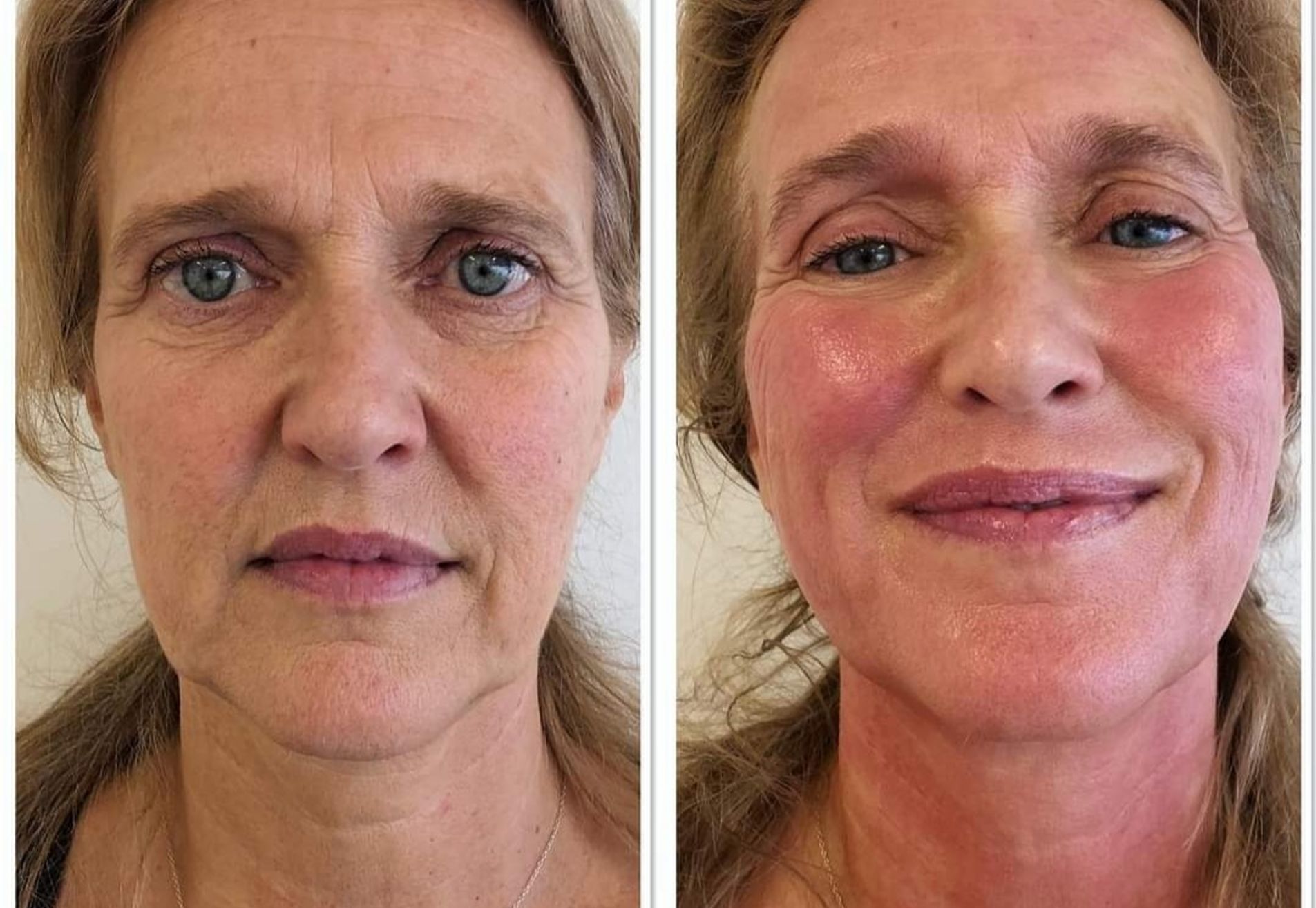 BN'er Ingeborg Wieten enorme huidverstrakking