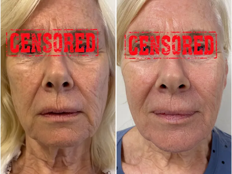 Scarlet-S RF: Strakkere huid, kleinere poriën en een frissere uitstraling