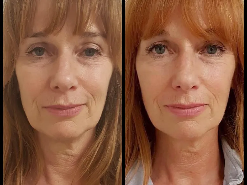 Scarlet-S geadviseerd door Dermatologen
